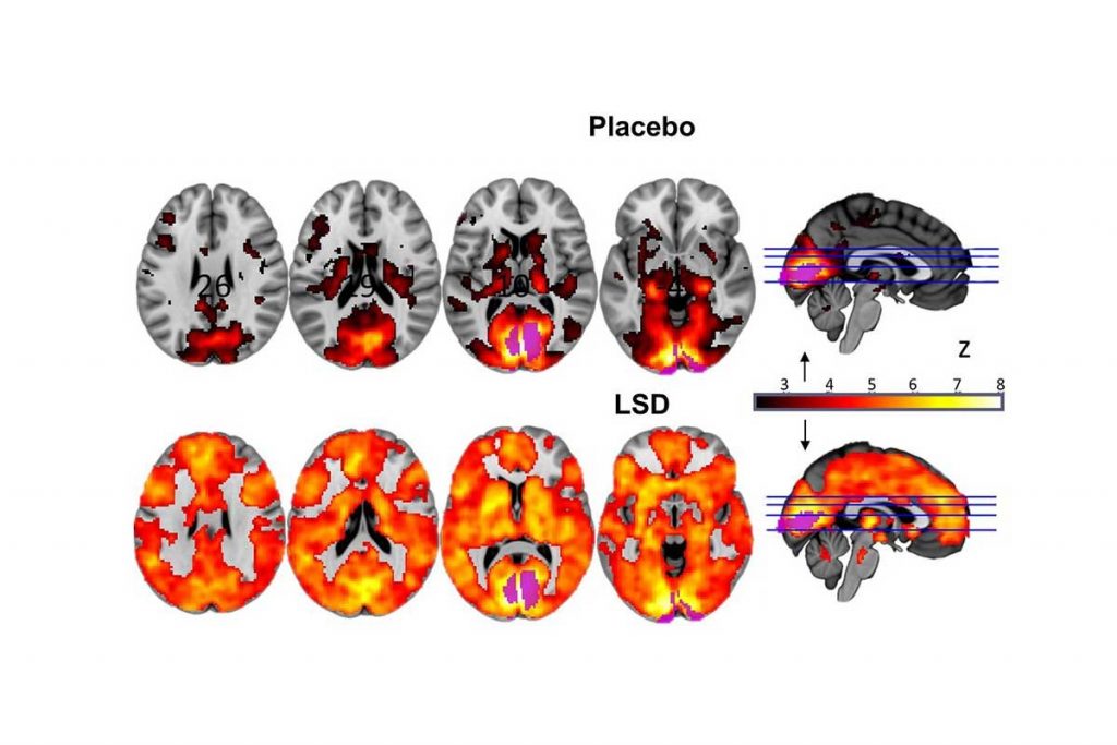 Verschil tussen een brein op placebo en op LSD. Bron: Carhart-Harris et al.