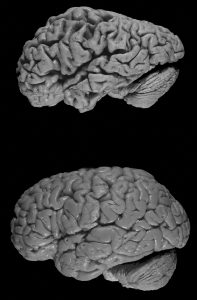 Alzheimer zorgt voor een vermindering van het breinweefsel. Beeld: wikimedia commons, Hersenbank