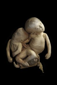 Een asymmetrische Siamese tweeling Bron: Marieke de Lorijn
