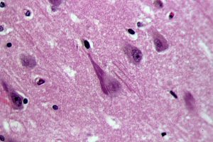 Neurofibrillary_tangles_in_the_Hippocampus_of_an_old_person_with_Alzheimer-related_pathology,_HE_3