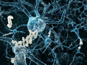 Alzheimerpatiënten vertonen ophopingen van plakkerige eiwitten in het brein. Beeld: Thinkstock