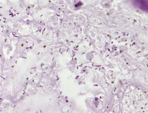 Donkerpaarse bacteriën in een hondentumor. Credit: David L. Huso and Baktiar Karim/Johns Hopkins Department of Pathology