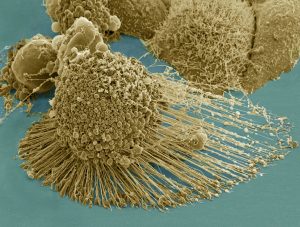 Kankercellen onder een elektronenmicroscoop. Bron: Wikimedia Commons