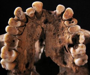 Ernstig tandbederf bij een jongvolwassen jager-verzamelaar uit Taforalt. Bron: Isabelle De Groote