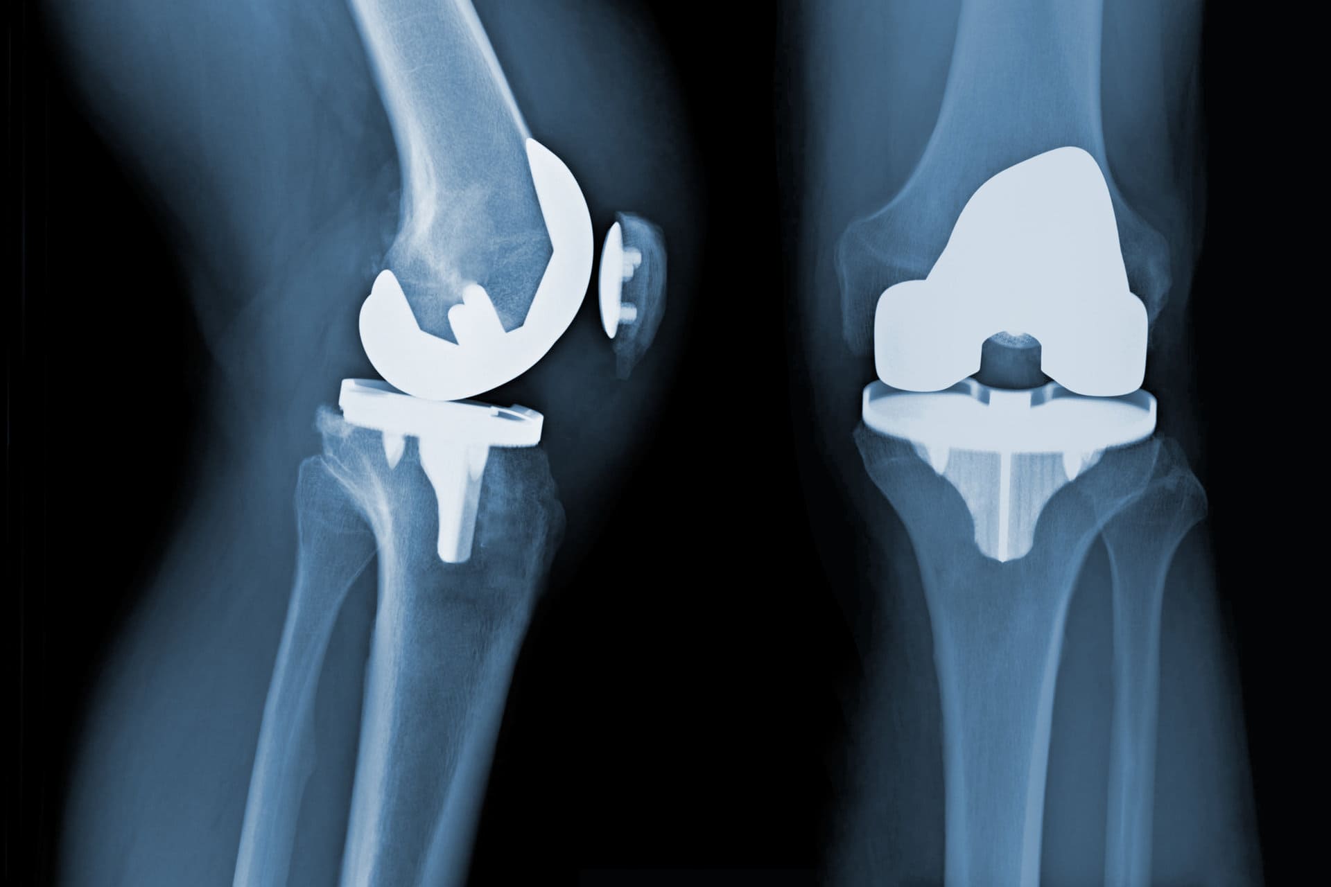 Il nuovo materiale per le protesi riduce il rischio di infezione