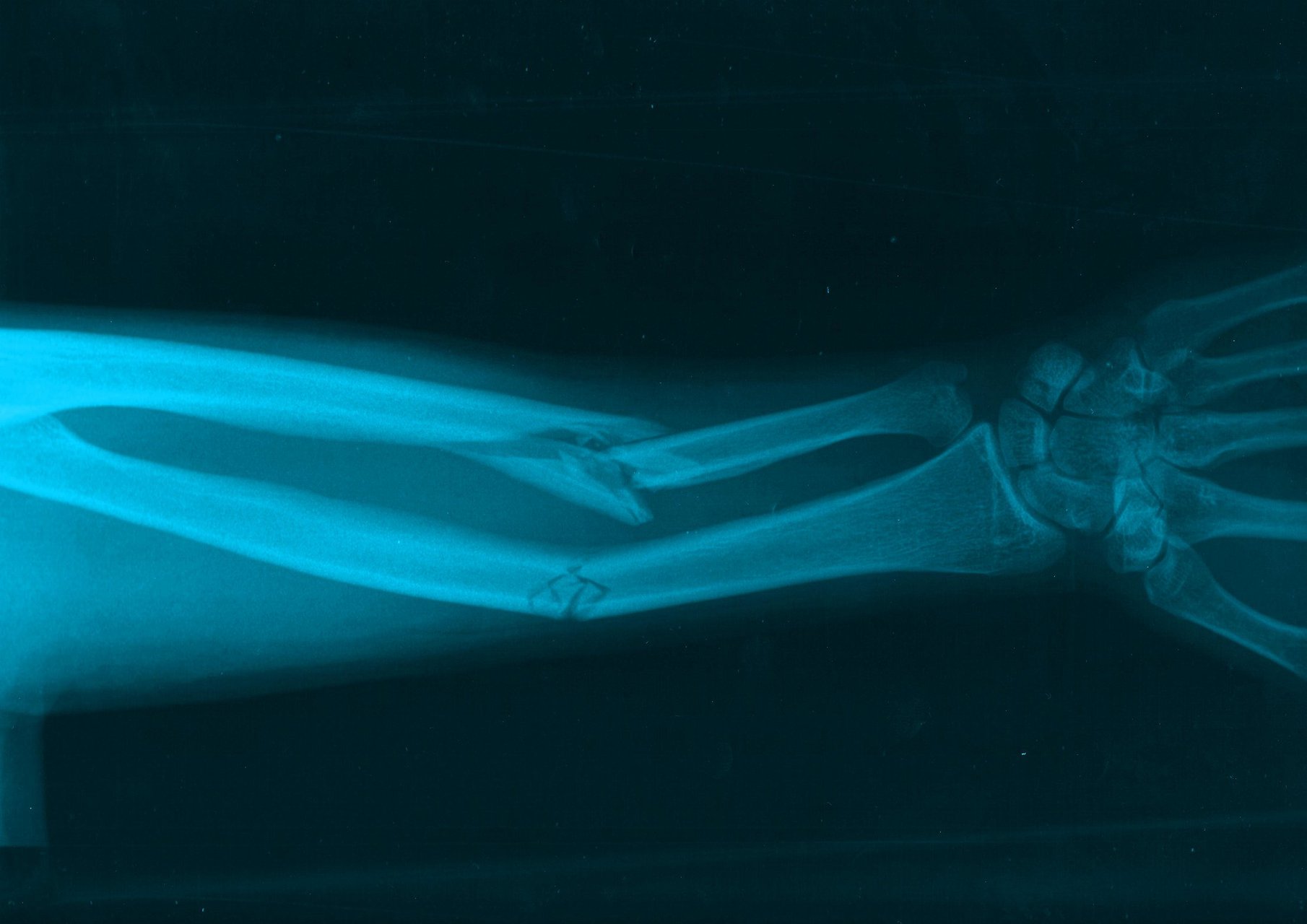 Открытый перелом кости руки. Перелом костей предплечья рентген. Рентген перелома кости предплечья. Рентген снимки переломов костей. Перелом костей руки - рентгены.