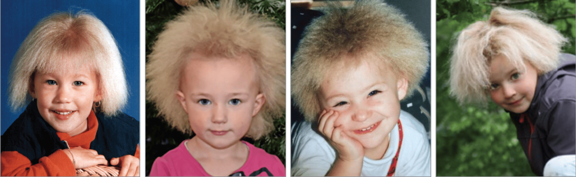 Researchers unravel genes behind uncombable hair syndrome - Techzle